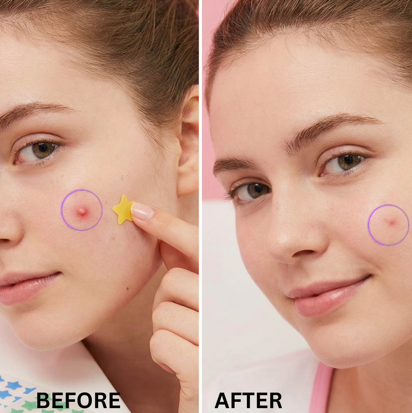 Star Perfections - Star Acne Patches